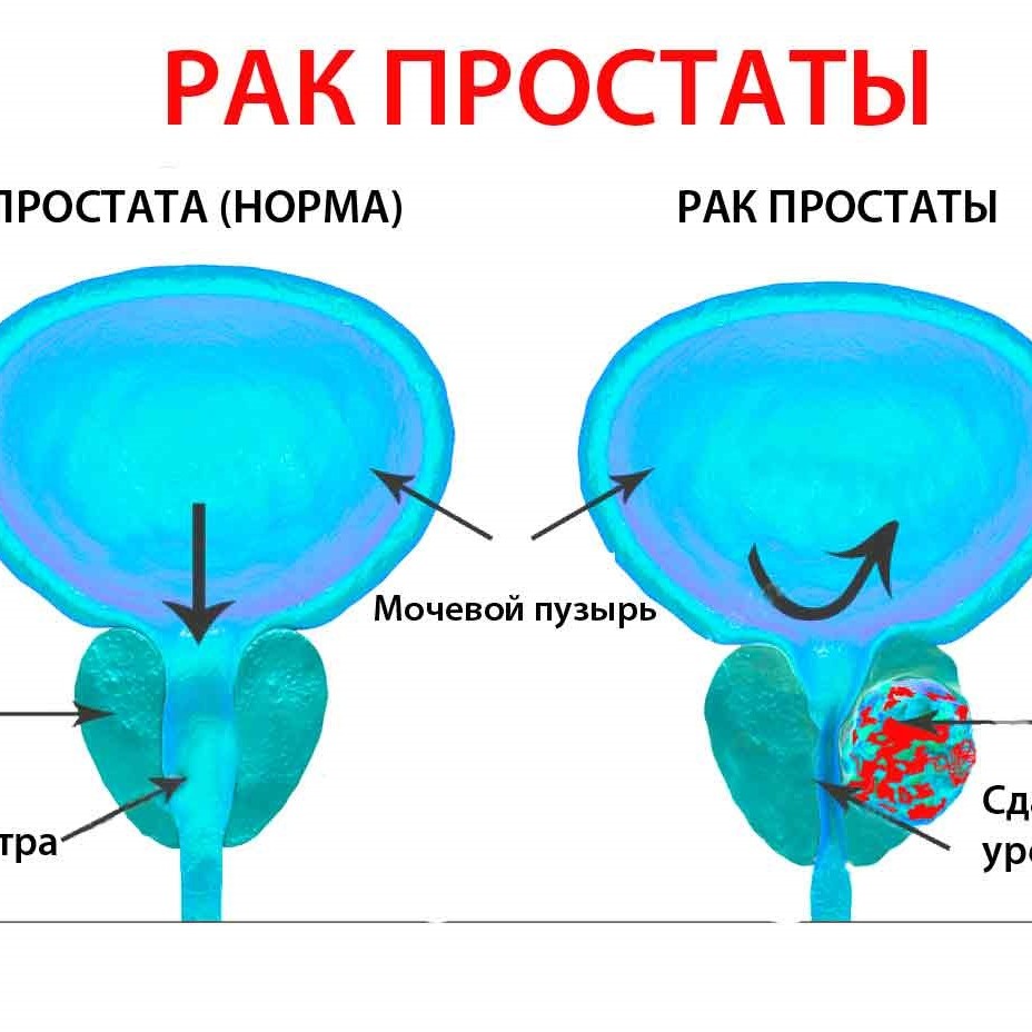 Рак простаты